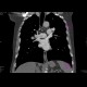 Acute lung embolism: CT - Computed tomography